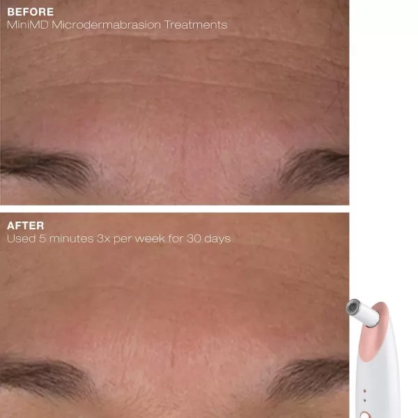 Trophy Skin MiniMD  Mini Handheld Microdermabrasion System  Improves Texture and Skin Tone