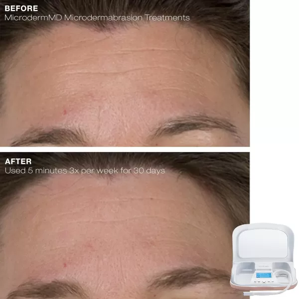 Trophy Skin MicrodermMD  At Home Microdermabrasion Kit  Anti Aging and Acne Treatment  Contains Real Diamond and Pore Extractor Tips to Rejuvenate Skin and Reduce Acne Scars  BlushWhite