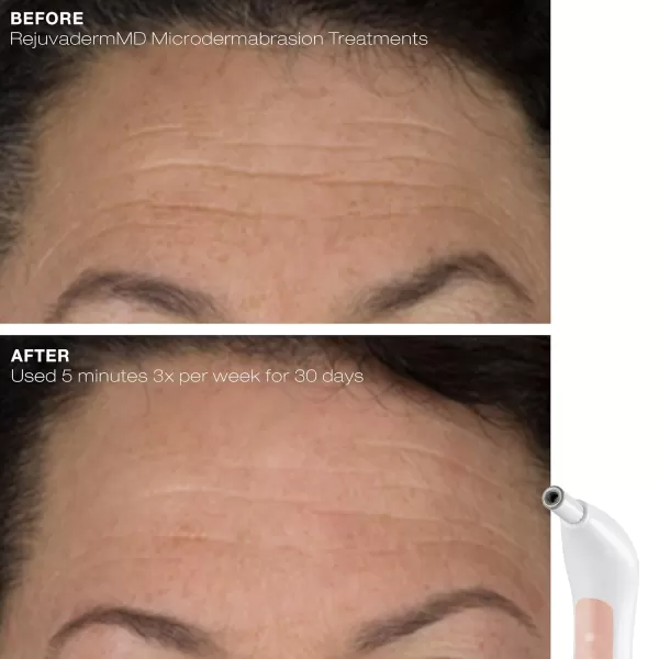 Trophy Skin RejuvadermMD  Microdermabrasion Machine OnTheGo  Facial Exfoliation with Real Diamond Tip for Radiant and Youthful Skin