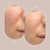 imageTrophy Skin Pore Infusion Tip  Compatible with Any Trophy Skin Microdermabrasion Machine  Opens Pores to Absorb Skin Care Product